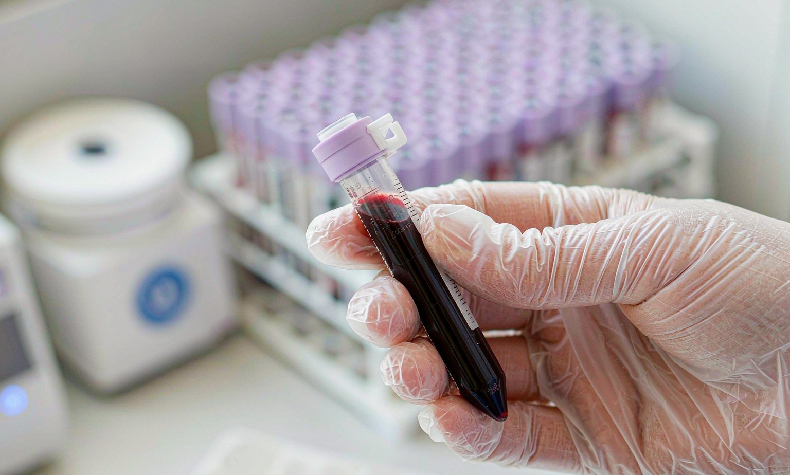 Blood Sample Collection for Methylated SEPT9 Colorectal Cancer Screening Test Blood collection tube for a plasma-based methylated SEPT9 DNA colorectal cancer screening test, held in a gloved hand in a clinical laboratory with plasma sample tubes in the background